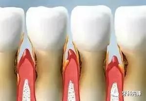 美辰口腔 | 牙龈萎缩的原因与预防！